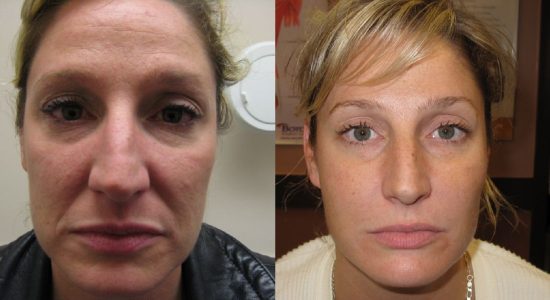 Face fillers before and after