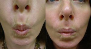 Botox for upper lip before and after