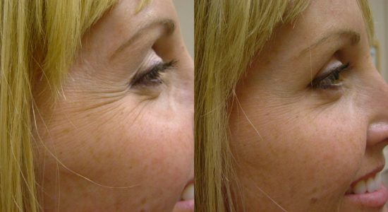 Botox treatment for crow's feet before and after photo