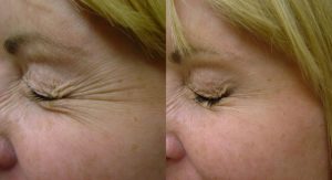 Botox treatment for crow's feet before and after
