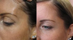 Filler in Temple and Brow Before and After