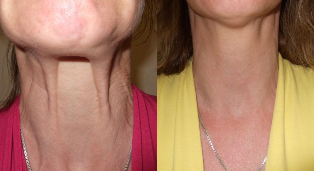 Wrinkle Treatment Before and After Botox, Dermal Fillers