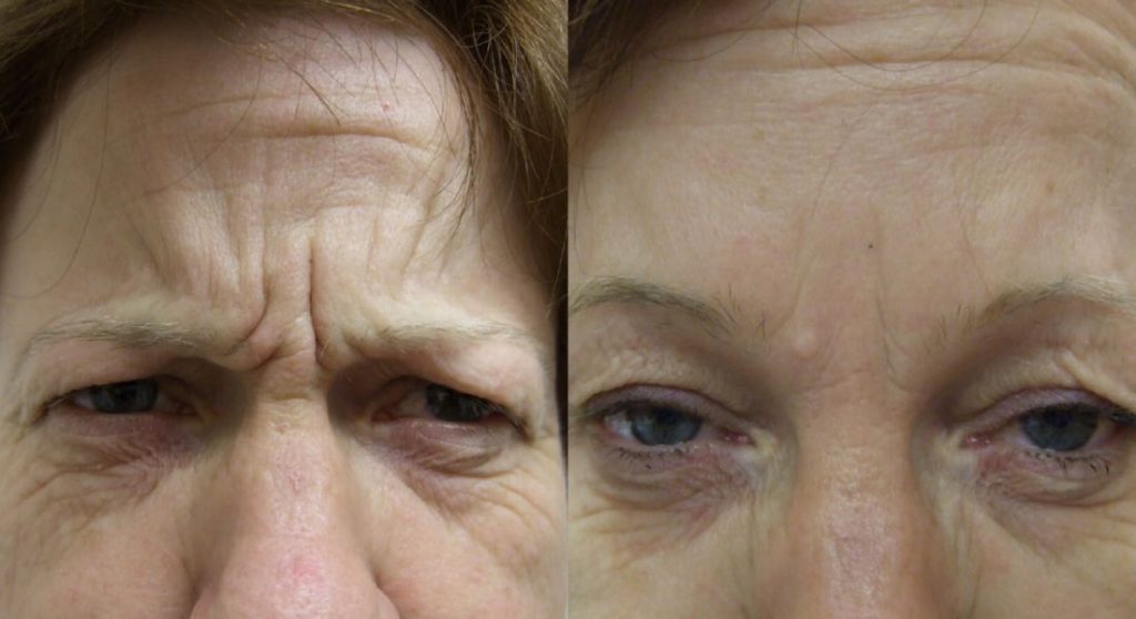 botox-injection-for-frown-lines-before-and-after