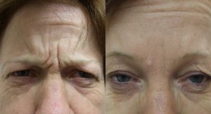 Botox Injection For Frown Lines Before and After