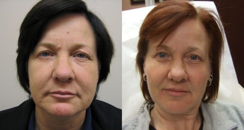 Face Filler For Marionette Lines Before and After