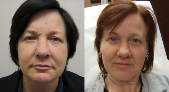 Face Filler For Marionette Lines Before and After