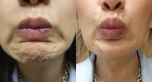 Botox Treatment For the Chin Before and After
