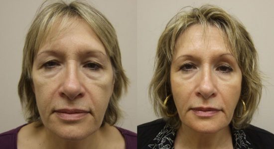 Cheek Fillers Before and After Photo