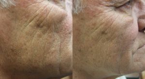 Cheek Filler Before and After