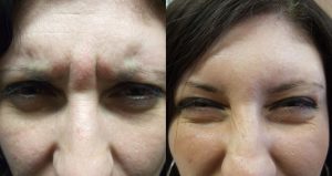 Botox For Frown Lines Before and After
