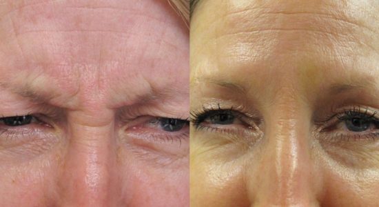 Botox Treatment For Frown Lines Before and After
