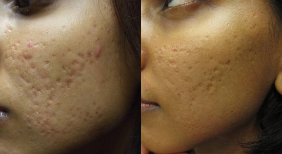 Fraxel Treatment Before and After
