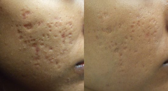 Acne Scar Treatment Before and After