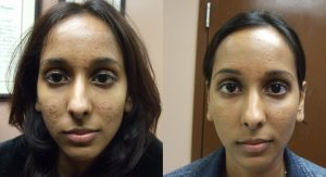 Acne Fraxel Treatment Before and After