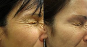 Botox for crow's feet treatment before and after