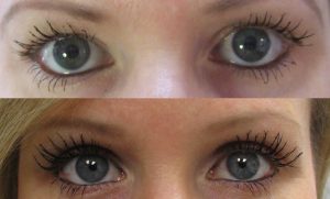 eyelash-latisse-before-after
