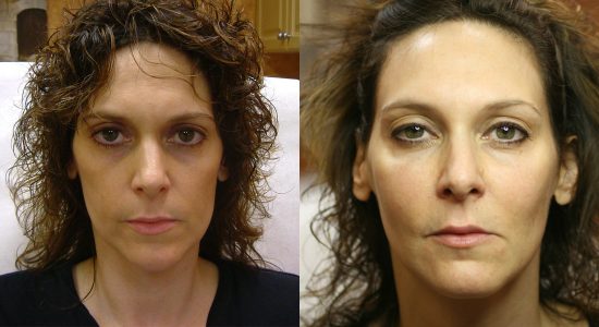 Filler Treatment Woman Before and After
