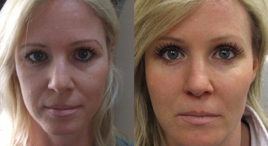 Face Filler Treatment Before and After Photo