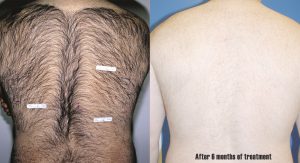 Laser Hair Removal Before and After Photo