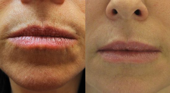 Botox lips before and after