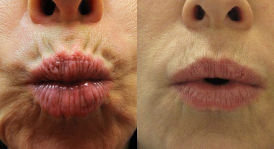 Lips Before and After Treatment