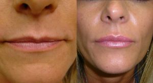 Lip Augmentation Before and After