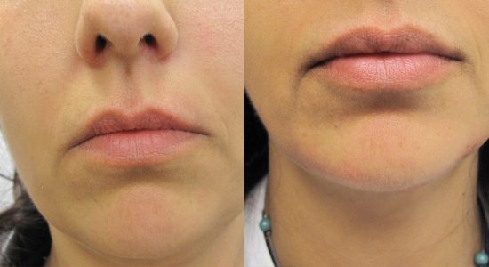 Lip Treatment Before and After
