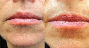 Fillers for lips before and after