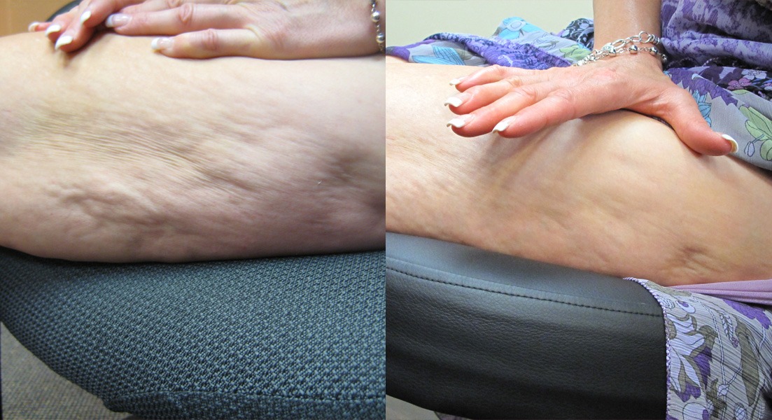 Cellulite treatment before and after of actual dM patients 