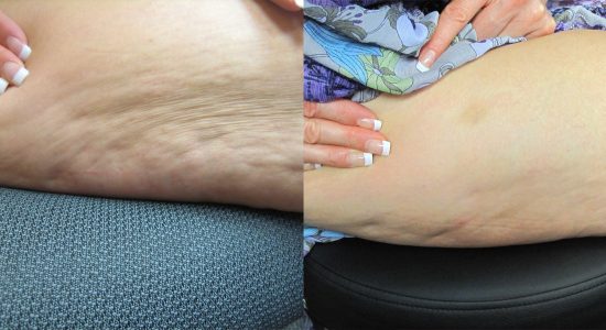 Maximus Cellulite Treatment Before and After Photo 3