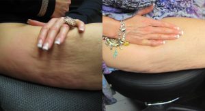 Maximus Cellulite Treatment Before and After Photo 2