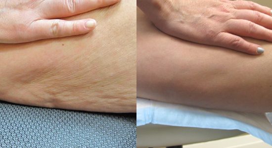 Maximus Cellulite Treatment Before and After Photo