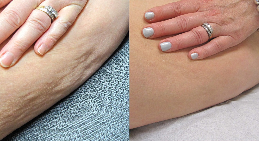 Cellulite treatment before and after of actual dM patients.
