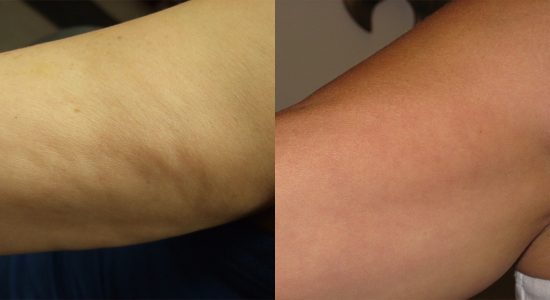 Maximus Cellulite Fat Treatment Before and After