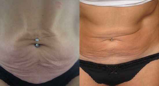 Maximus Treatment For Cellulite Before and After Photo