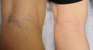 Sclerotherapy Treatment Before and After