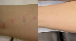 Sclerotherapy Before and After Treatment