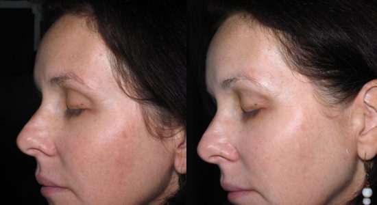 Skincare before and after photo