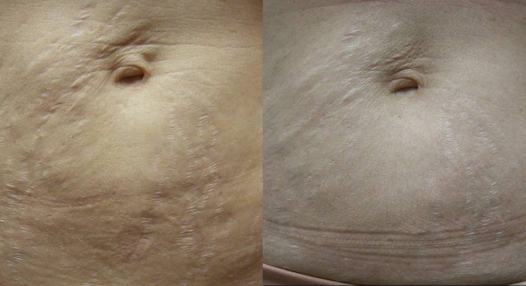 Stretch Mark Treatment Results | DM Cosmetic and Wellness