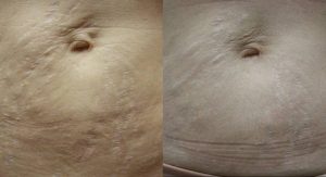 Stretch Marks On Belly Treatment Before and After