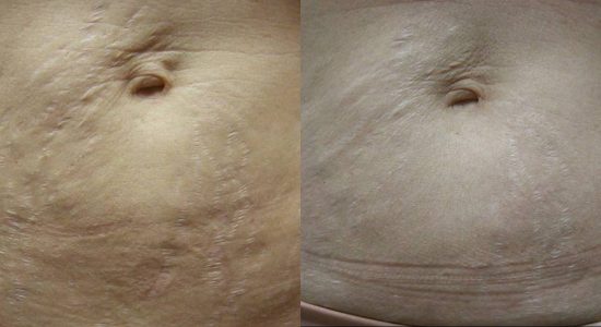 Stretch Marks On Belly Treatment Before and After