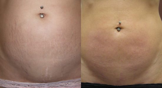 Stretch Marks On Stomach Treatment Before and After