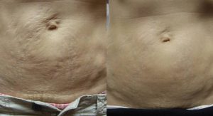 Stretch Marks Treatment Before and After