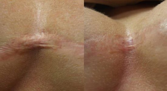 Scar Treatment Before and After