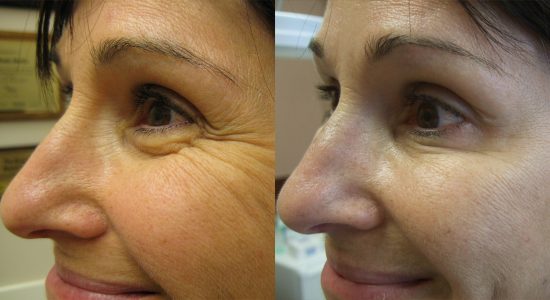 Botox for Crow's Feet Before and After