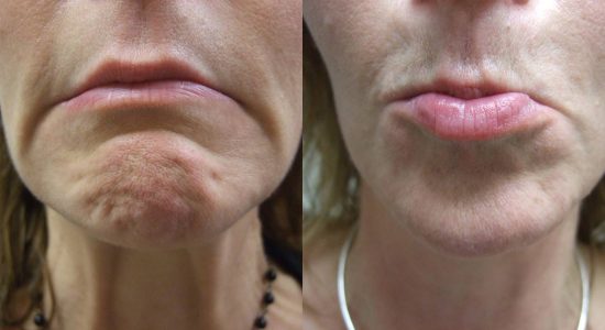 Chin wrinkles treatment before and after