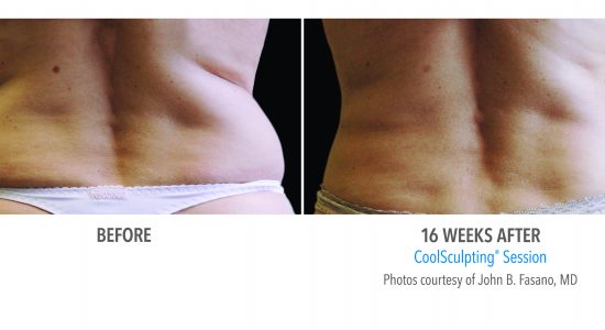 CoolSculpting Love Handles Woman Before and After Photos