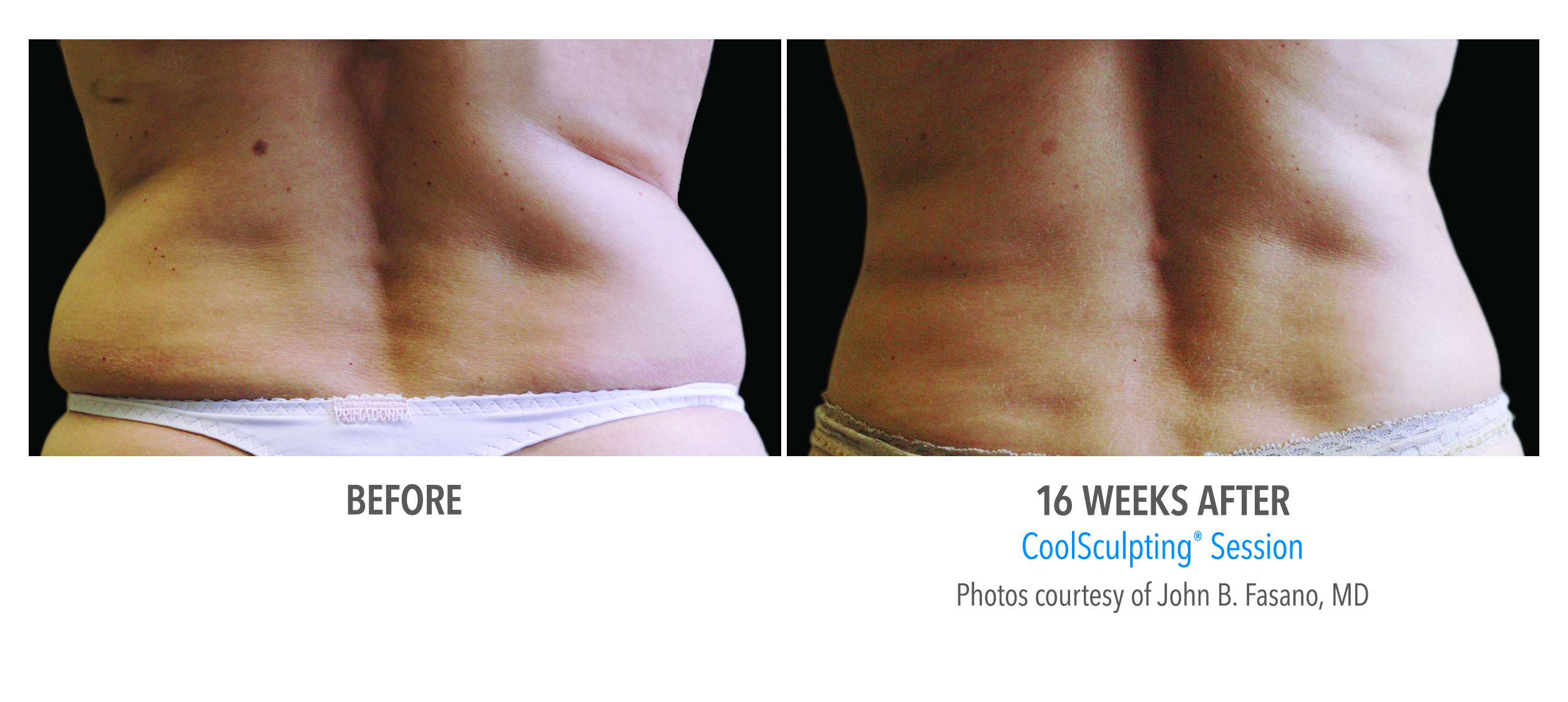 Coolsculpting Love Handles Woman Before And After Photos