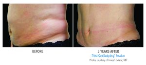 CoolSculpting Stomach Before and After Photos