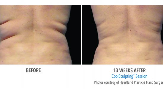 CoolSculpting Love Handles Before and After Photos